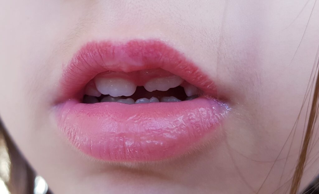 Myofunktionelle Therapie – Mundatmung